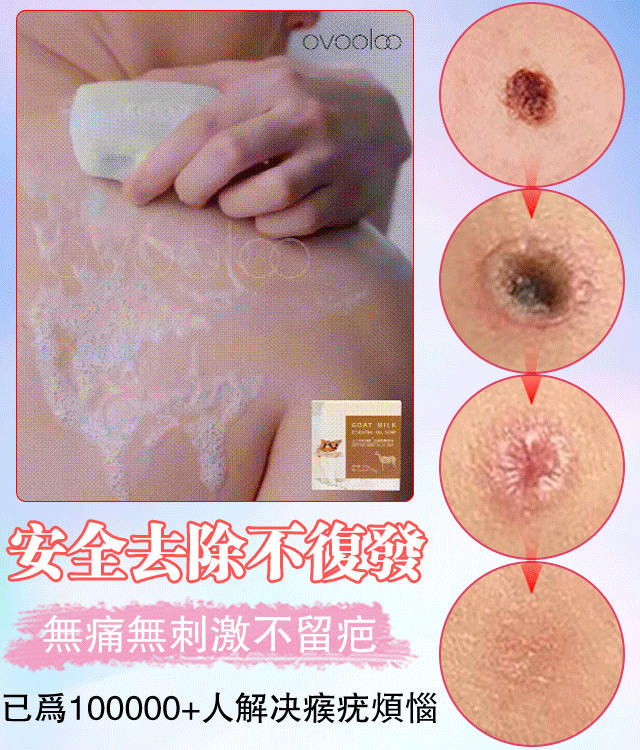 山羊奶去疣精油皂無需手術 衹需一洗輕鬆解决問題 山羊奶去疣精油皂無需手術 衹需一洗輕鬆解决問題
