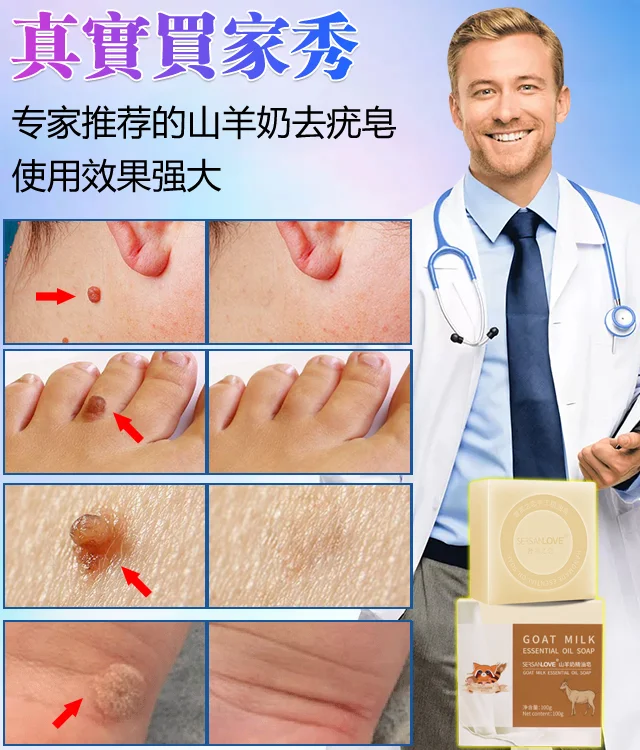山羊奶去疣精油皂無需手術 衹需一洗輕鬆解决問題 山羊奶去疣精油皂無需手術 衹需一洗輕鬆解决問題